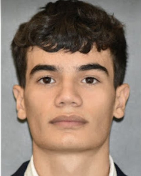 Patient 1 before orthognathic surgery, frontal view
