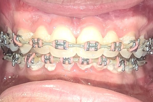 Patient 1 bite after orthognathic surgery