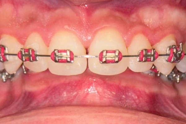 Patient 1 bite before orthognathic surgery