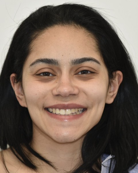 Patient 2 after orthognathic surgery, frontal view