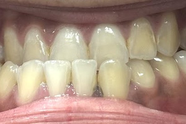 Patient 2 bite before orthognathic surgery