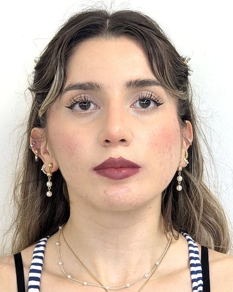 Patient 3 after orthognathic surgery, frontal view
