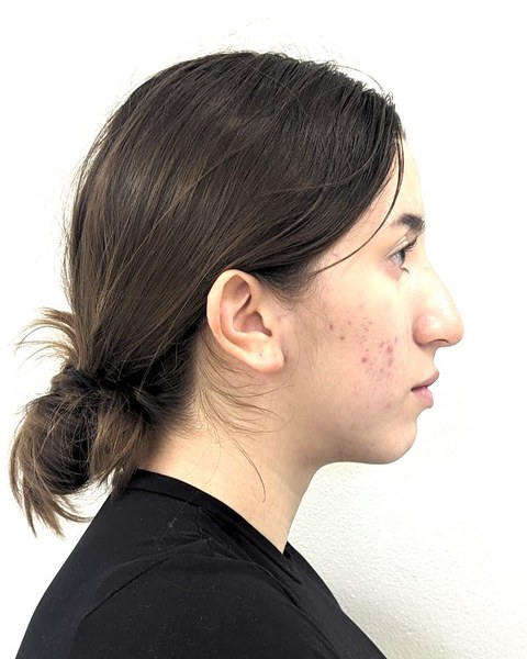 Patient 3 before orthognathic surgery, profile view