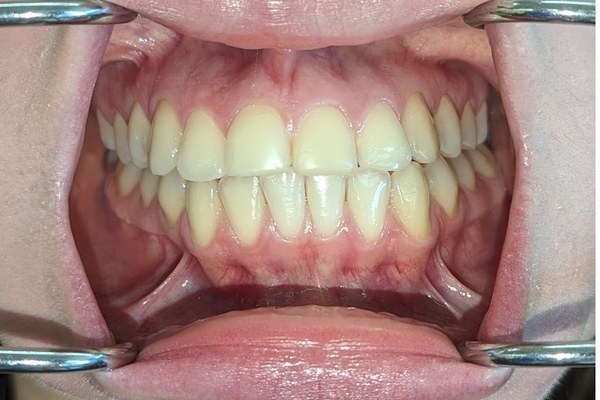 Patient 3 bite before orthognathic surgery