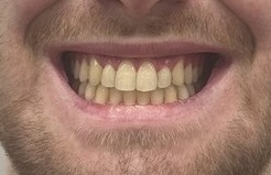 Patient 4 smile after orthognathic surgery