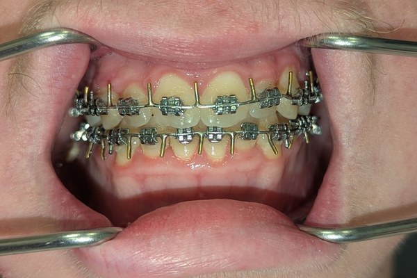 Patient 5 bite after orthognathic surgery