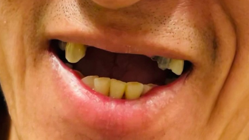 Before upper All-on-Four dental implant procedure