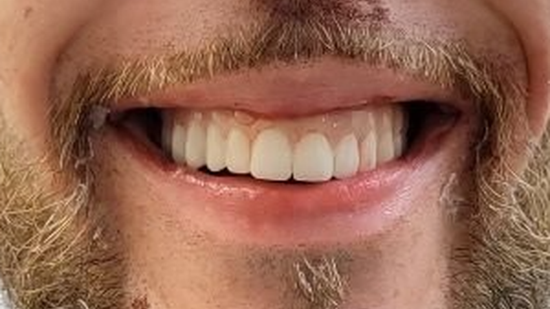 After full smile transformation with dental implants